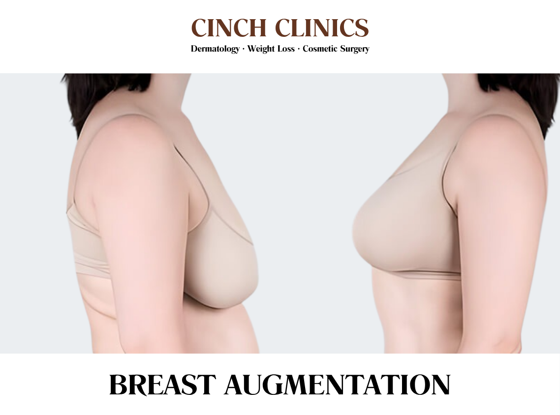 Breast Augmentation at Cinch Clinics